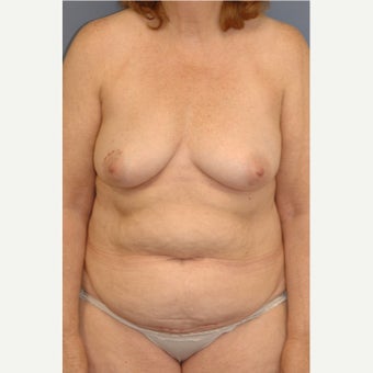 45-54 year old woman treated with Breast Reconstruction before 1835969