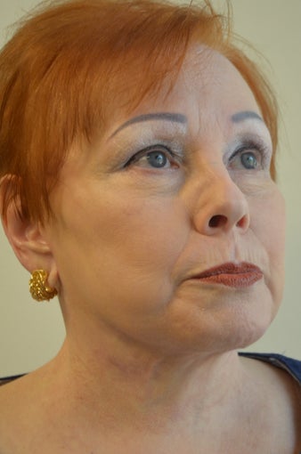 65-74 year old woman treated with Facelift, Neck Liposuction, and Perioral Dermabrasion 3371402