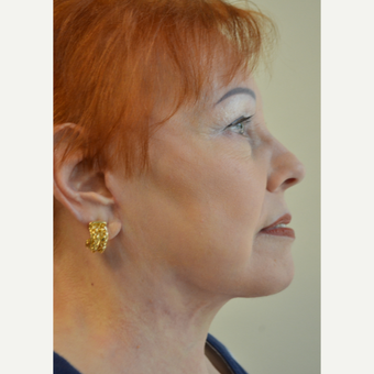 65-74 year old woman treated with Facelift, Neck Liposuction, and Perioral Dermabrasion after 3371402