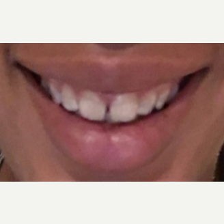 25-34 year old woman treated with Botox for Gummy Smile after 3092362