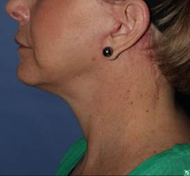 face and neck lift 56 year old after 1336029