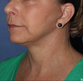 face and neck lift 56 year old 1336029