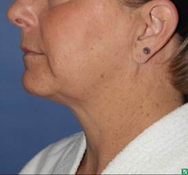face and neck lift 56 year old before 1336029