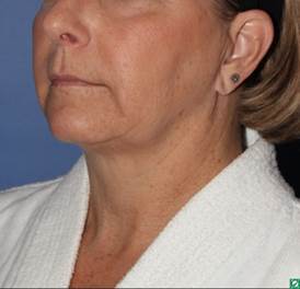 face and neck lift 56 year old 1336029