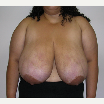 25-34 year old woman treated with Breast Reduction before 3683573