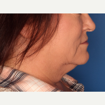 52 year old woman treated with Kybella before 3709965