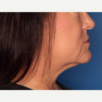 52 year old woman treated with Kybella after 3709965