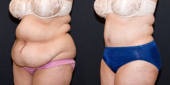 Tummy Tuck before 1498821