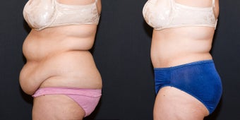 Tummy Tuck after 1498821