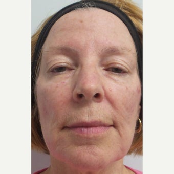 55-64 year old woman treated with Restylane Lyft to cheeks and marionettes after 2363720