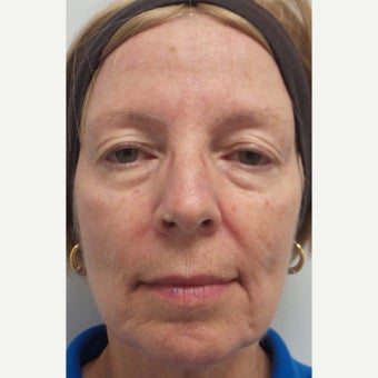 55-64 year old woman treated with Restylane Lyft to cheeks and marionettes before 2363720