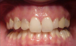 25-34 year old patients treated with Digitally produced Cerac Crowns before 3093028