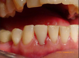 25-34 year old patients treated with Digitally produced Cerac Crowns 3093028