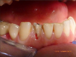 25-34 year old patients treated with Digitally produced Cerac Crowns 3093028