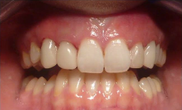 25-34 year old patients treated with Digitally produced Cerac Crowns after 3093028
