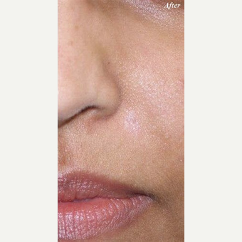 25-34 year old woman treated with Mole Removal after 3711261