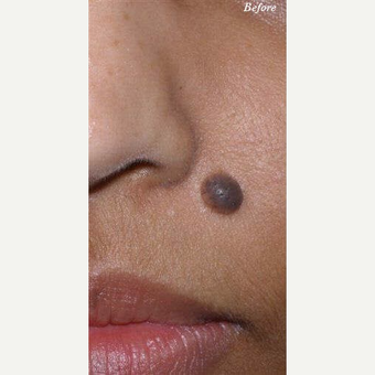 25-34 year old woman treated with Mole Removal before 3711261
