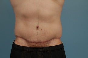 Abdominoplasty after 1065507