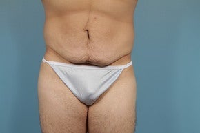 Abdominoplasty before 1065507