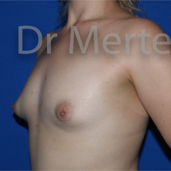 25-34 year old woman treated with Breast Lift with Implants before 3591746
