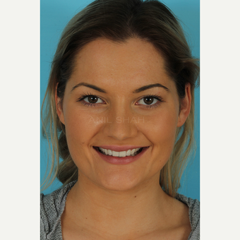 25-34 year old woman treated with Rhinoplasty after 3691101