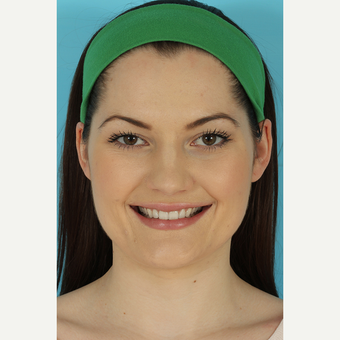 25-34 year old woman treated with Rhinoplasty before 3691101