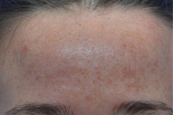 25-34 year old woman treated with Laser Resurfacing before 3141104