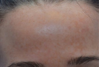 25-34 year old woman treated with Laser Resurfacing after 3141104