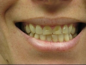 BriteSmile in-office bleaching and 6 porcelain crowns. before 996248