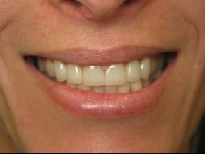 BriteSmile in-office bleaching and 6 porcelain crowns. after 996248