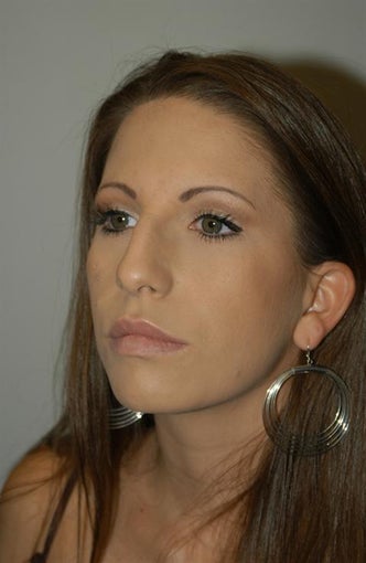 25-34 year old woman treated with Rhinoplasty 1807160