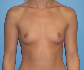 Breast Augmentation 22 Year Old before 1035215