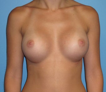 Breast Augmentation 22 Year Old after 1035215