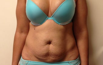 Abdominoplasty before 1190639