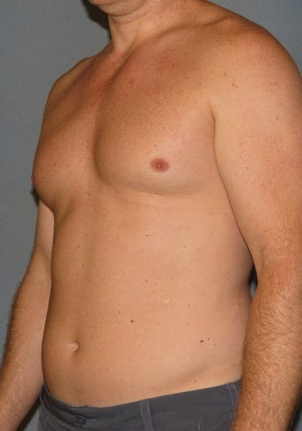 35-44 year old man treated with "Abdominal Etching" Liposuction before 2038987