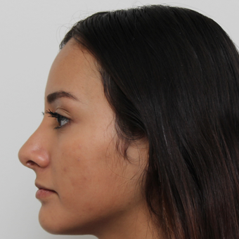 17 or under year old woman treated with Rhinoplasty after 3418784