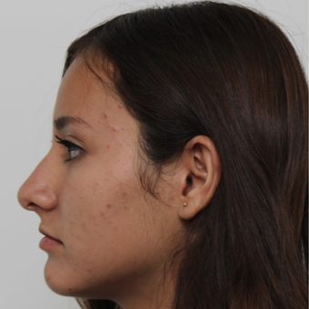 17 or under year old woman treated with Rhinoplasty before 3418784