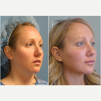 25-34 year old woman treated with Facelift before 3847240