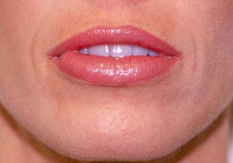 Before and After Upper & Lower Lip Lift after 65360