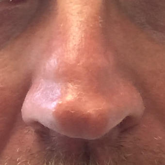 Rhinoplasty to correct multiple nasal deformities: 45-54 year old male before 3847512