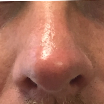 Rhinoplasty to correct multiple nasal deformities: 45-54 year old male after 3847512