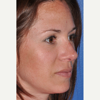 Rhinoplasty for Improved Profile and Nasal Tip after 3702949