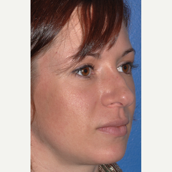 Rhinoplasty for Improved Profile and Nasal Tip before 3702949