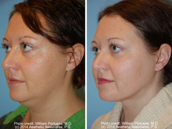 Neck Liposuction before 1389498