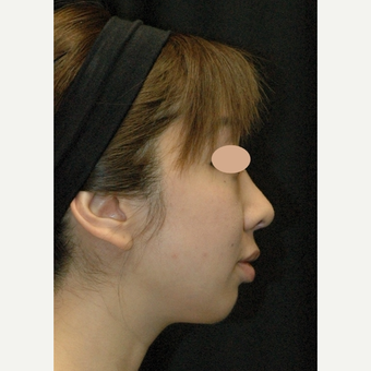 25-34 year old woman treated with Asian Rhinoplasty after 3783110