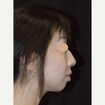 25-34 year old woman treated with Asian Rhinoplasty before 3783110