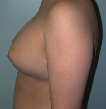 Young Female Undergoes Breast Augmentation as part of a Male to Female Transformation 1190950