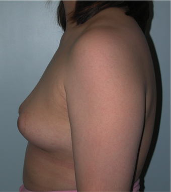 Young Female Undergoes Breast Augmentation as part of a Male to Female Transformation 1190950