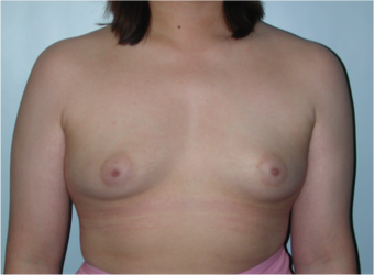 Young Female Undergoes Breast Augmentation as part of a Male to Female Transformation before 1190950