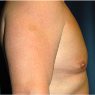 50 year old man treated with Male Breast Reduction after 3720893